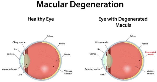 WHAT YOU SHOULD KNOW ABOUT THE EYE DISEASE MACULAR DEGENERATION