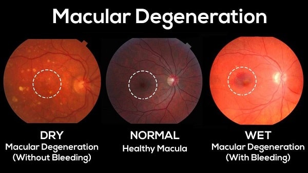 WHAT YOU SHOULD KNOW ABOUT THE EYE DISEASE MACULAR DEGENERATION