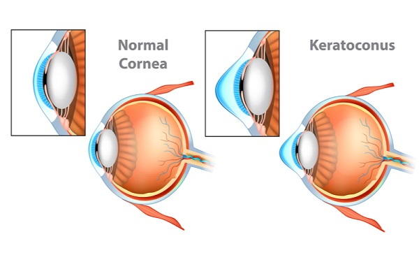 science of keratoconus