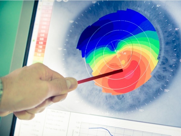 keratoconus diagnosis