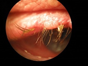 Blepharitis