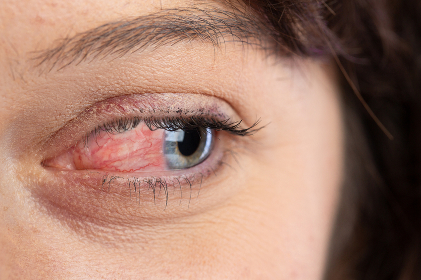 What Is Dry Eye Syndrome?