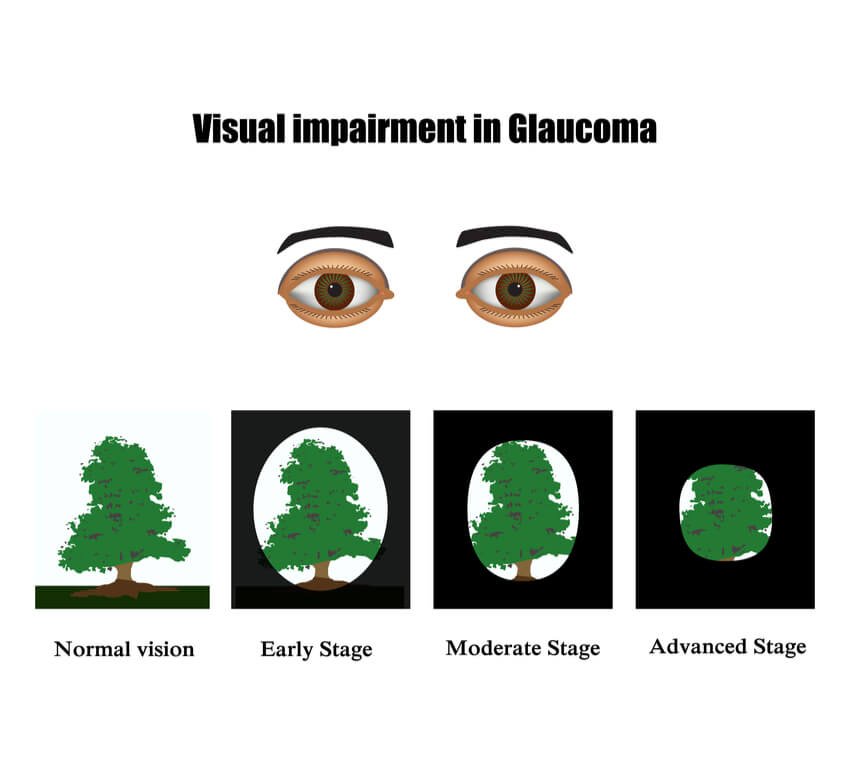 Signs Of Glaucoma