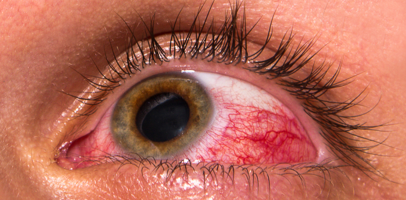 Our guide to eye injury prevention